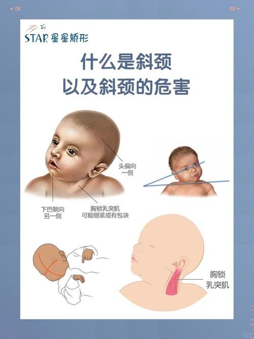 新生儿先天性斜颈能治好吗?-第1张图片-郑州医学网 新生儿先天性斜颈能治好吗?-第1张图片-郑州医学网