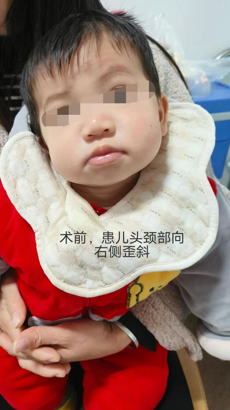 新生儿先天性斜颈能治好吗?-第3张图片-郑州医学网 新生儿先天性斜颈能治好吗?-第3张图片-郑州医学网