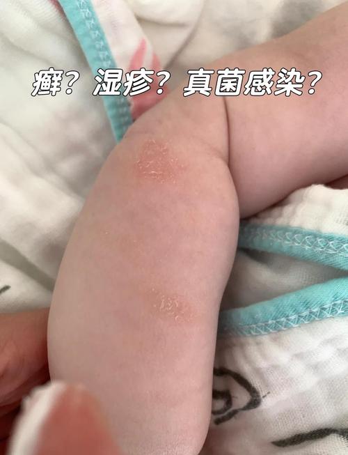 新生儿脱皮是正常现象吗?-第1张图片-郑州医学网 新生儿脱皮是正常现象吗?-第1张图片-郑州医学网