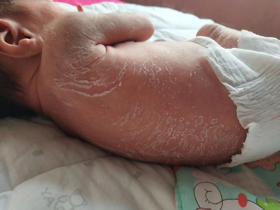 新生儿脱皮是正常现象吗？-第2张图片-郑州医学网