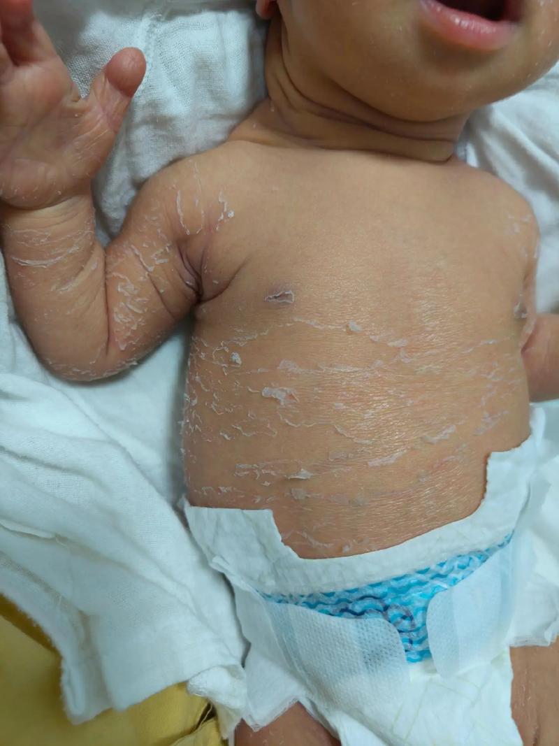 新生儿脱皮是正常现象吗？-第3张图片-郑州医学网