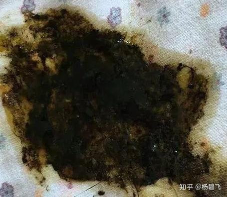 新生儿黑色便便是何原因？-第2张图片-郑州医学网