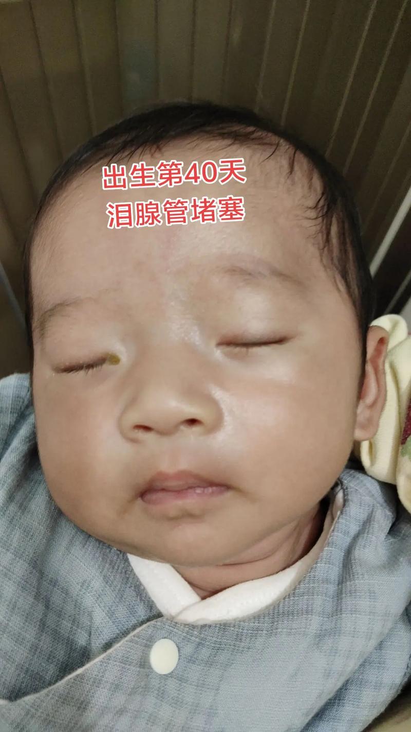 新生儿眼睛流泪又长眼屎,是正常还是生病了?-第1张图片-郑州医学网 新生儿眼睛流泪又长眼屎,是正常还是生病了?-第1张图片-郑州医学网