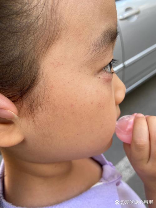 新生儿脸上小红点咋办?-第2张图片-郑州医学网 新生儿脸上小红点咋办?-第2张图片-郑州医学网