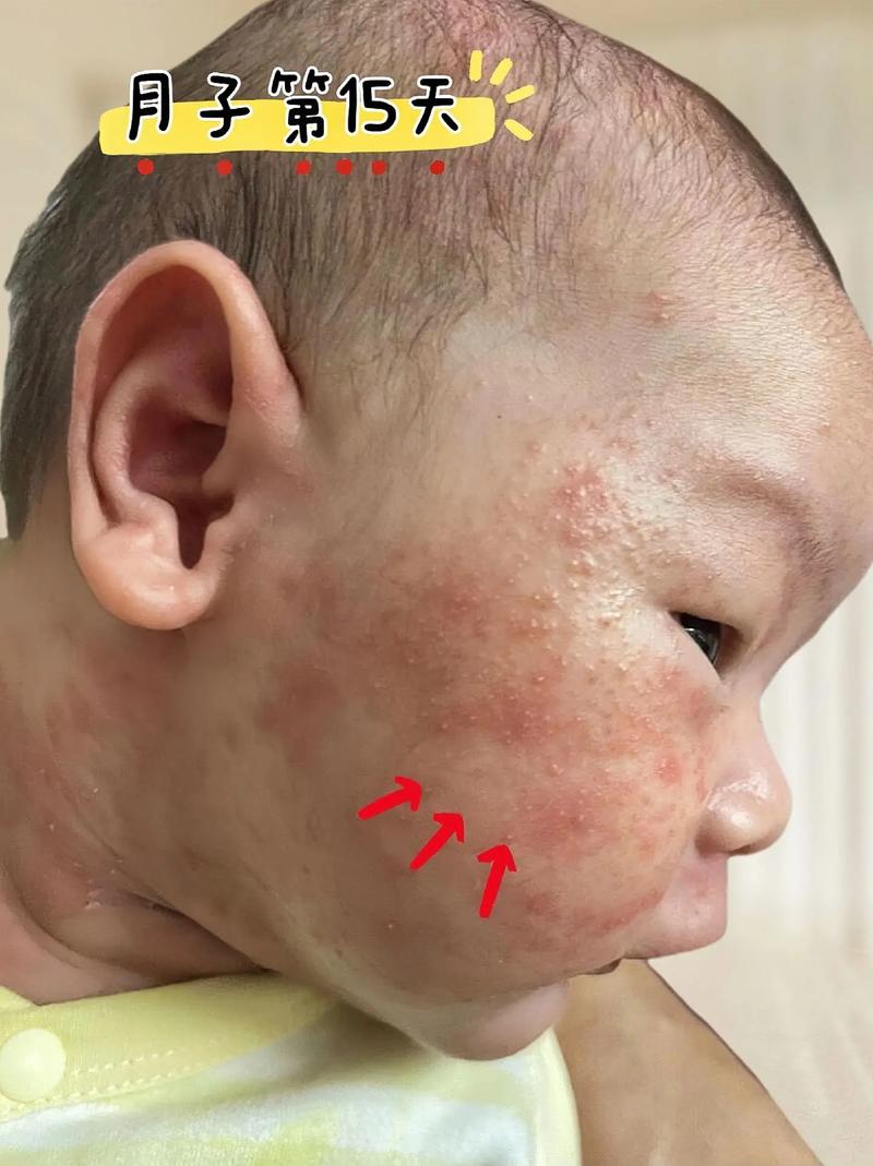 新生儿脸上小红点咋办?-第1张图片-郑州医学网 新生儿脸上小红点咋办?-第1张图片-郑州医学网