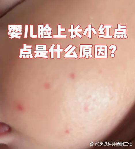 新生儿脸上小红点咋办?-第3张图片-郑州医学网 新生儿脸上小红点咋办?-第3张图片-郑州医学网