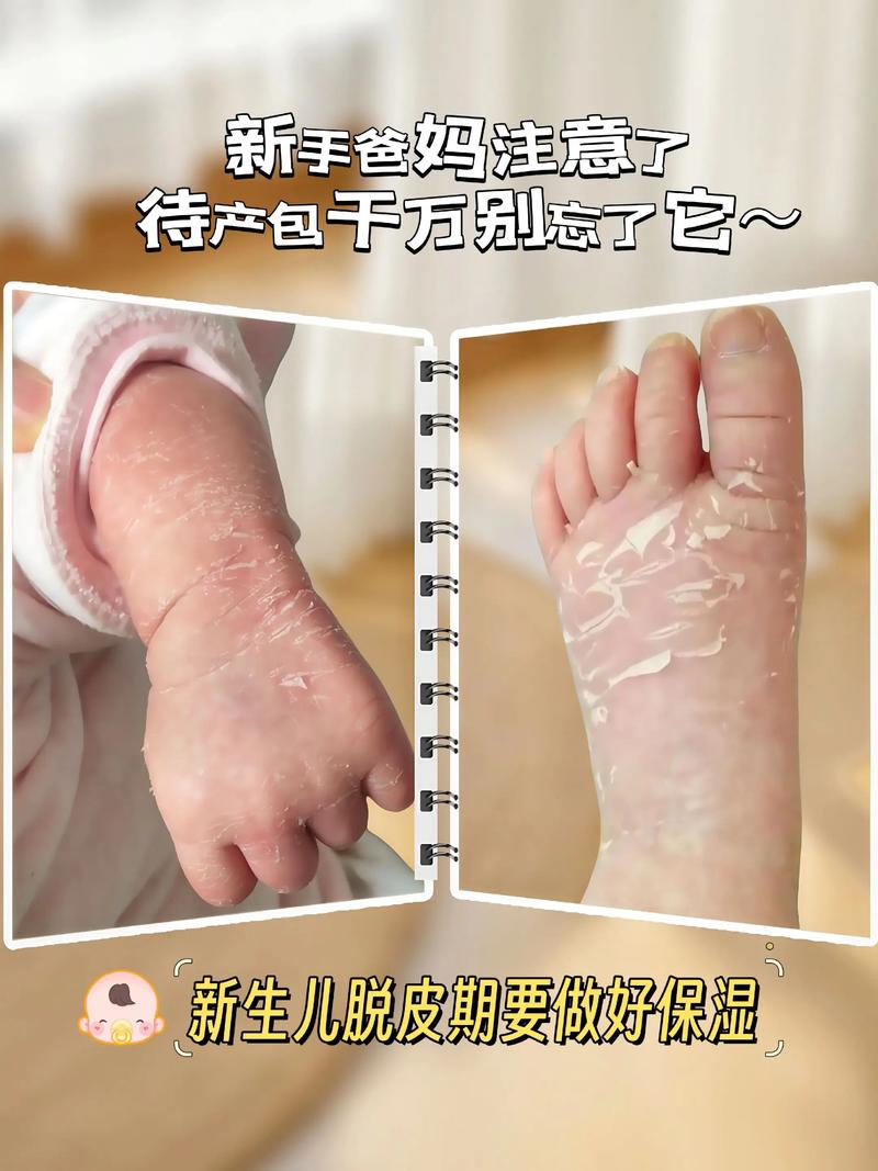 新生儿皮肤脱皮是正常现象吗?-第2张图片-郑州医学网 新生儿皮肤脱皮是正常现象吗?-第2张图片-郑州医学网