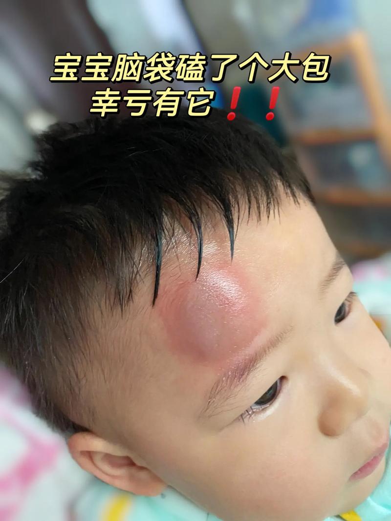 新生儿脸上发青是怎么回事-第1张图片-郑州医学网