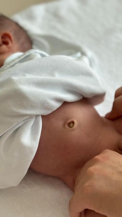 新生儿肚脐,酒精碘伏哪个更合适?-第2张图片-郑州医学网 新生儿肚脐,酒精碘伏哪个更合适?-第2张图片-郑州医学网