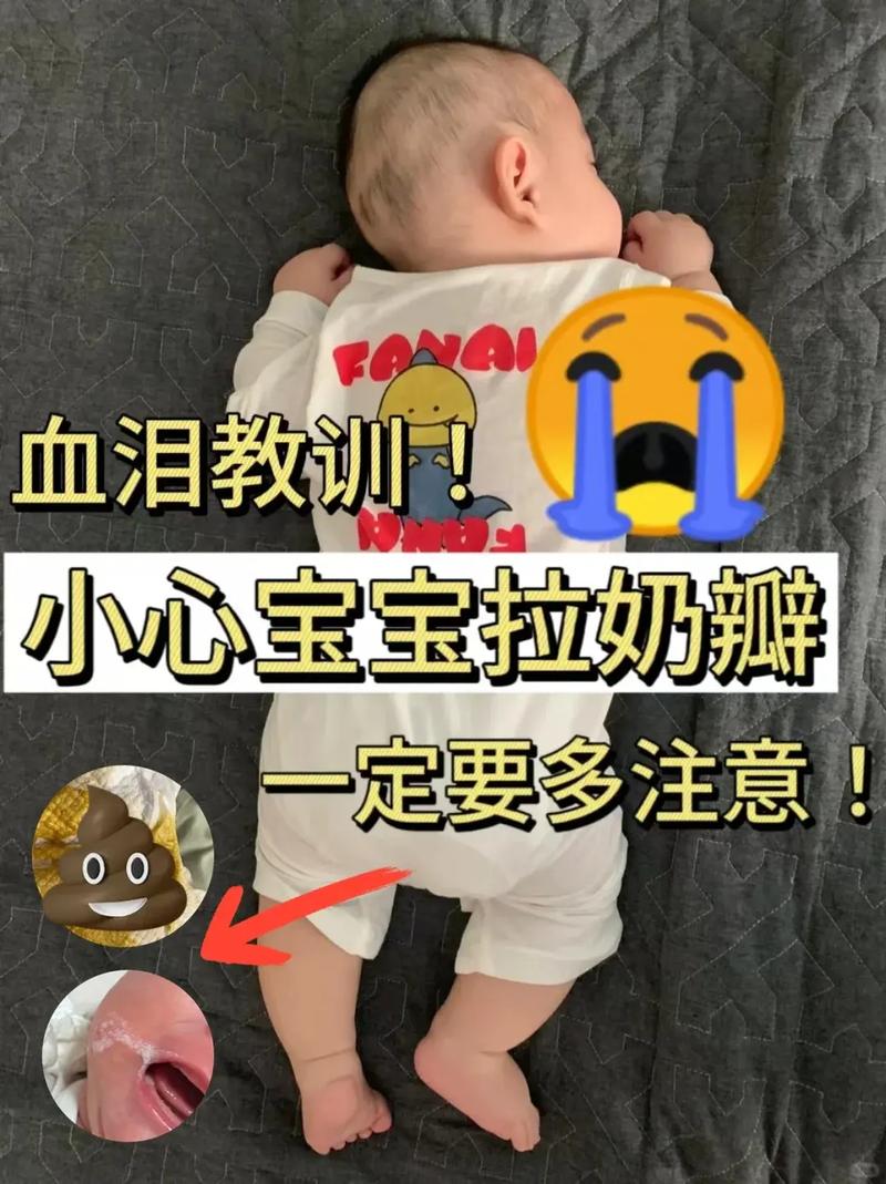 新生儿拉肚子有奶瓣咋办？-第2张图片-郑州医学网
