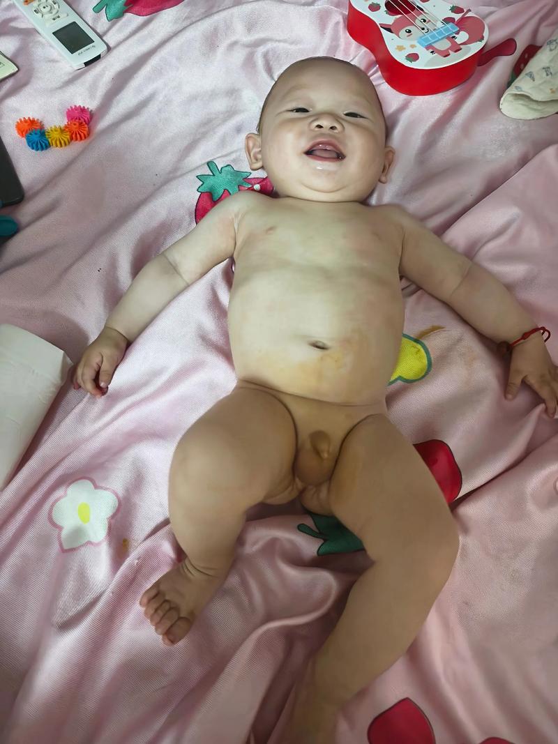 新生儿短肠50cm能存活吗？-第2张图片-郑州医学网