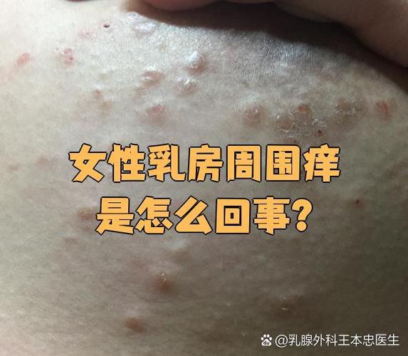 怀孕期间胸痒是正常现象吗？-第3张图片-郑州医学网