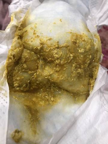 新生儿混合喂养大便有奶瓣怎么办？-第1张图片-郑州医学网