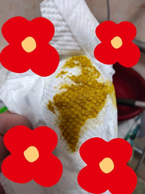 新生儿混合喂养大便有奶瓣怎么办？-第2张图片-郑州医学网