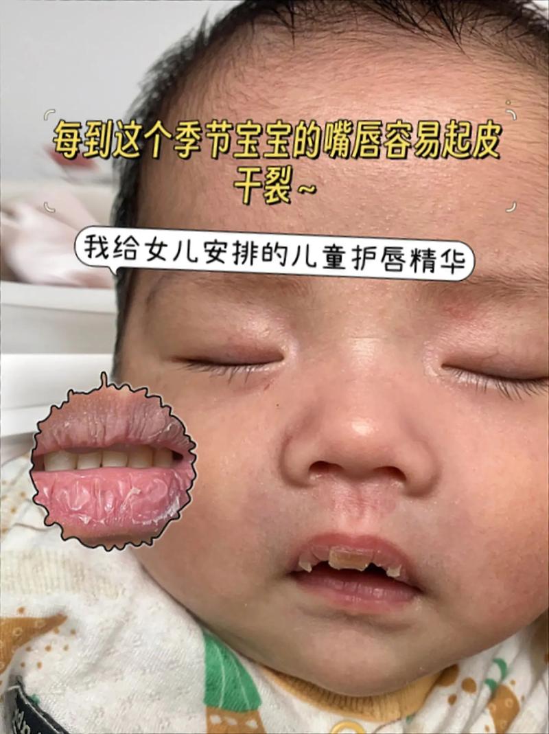 新生儿嘴唇脱皮是何原因？-第1张图片-郑州医学网