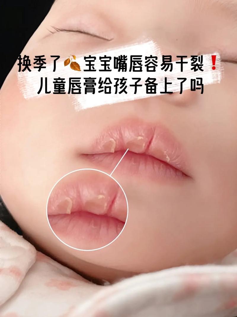新生儿嘴唇脱皮是何原因？-第2张图片-郑州医学网