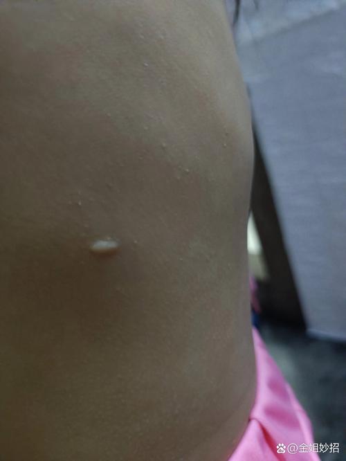 新生儿肾上腺皮质增生有哪些典型症状？-第3张图片-郑州医学网