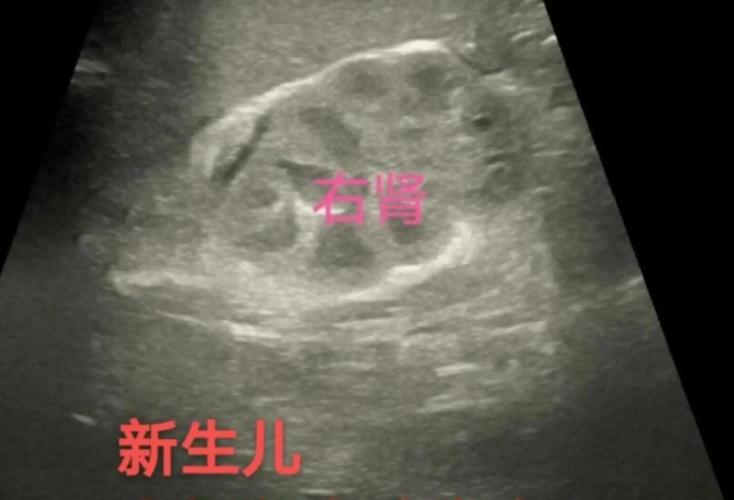 新生儿肾上腺皮质增生有哪些典型症状？-第1张图片-郑州医学网