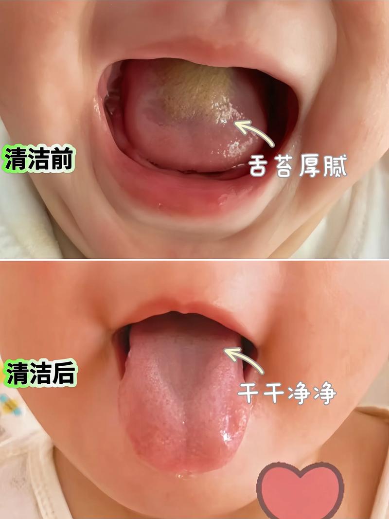 新生儿舌苔白是何原因所致?-第2张图片-郑州医学网 新生儿舌苔白是何原因所致?-第2张图片-郑州医学网