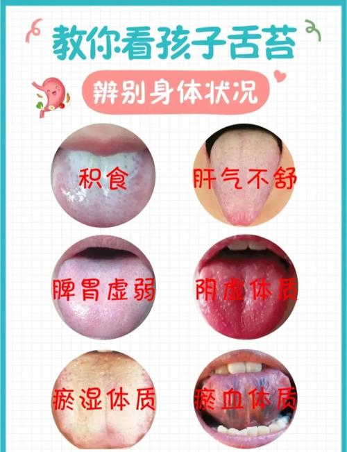 新生儿舌苔白是何原因所致?-第3张图片-郑州医学网 新生儿舌苔白是何原因所致?-第3张图片-郑州医学网