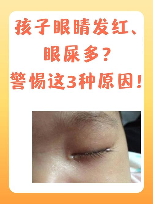 新生儿眼角眼屎多，是上火还是疾病？-第1张图片-郑州医学网