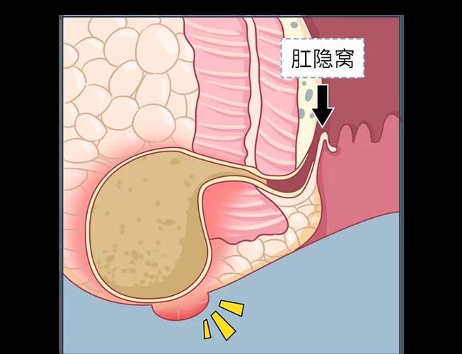 新生儿肛门脓肿最佳治疗方法是什么？-第2张图片-郑州医学网
