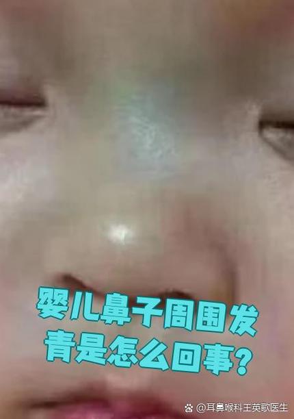 新生儿口周发青是缺氧吗？-第3张图片-郑州医学网