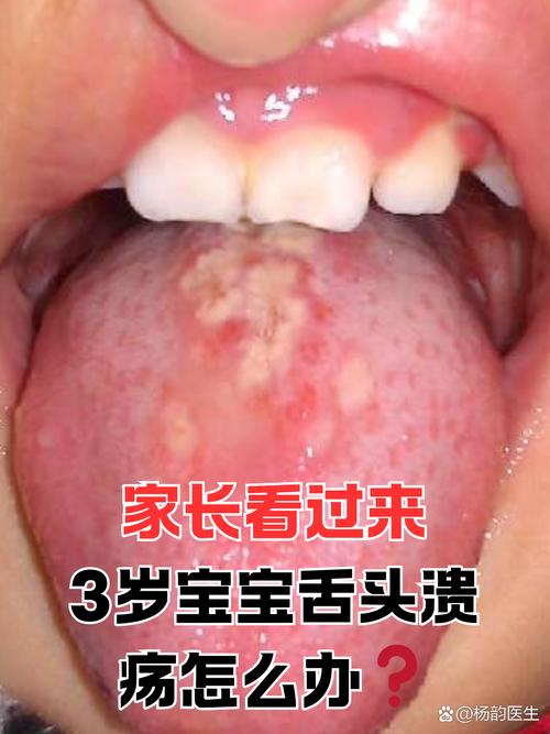 新生儿舌尖发红是怎么回事-第2张图片-郑州医学网