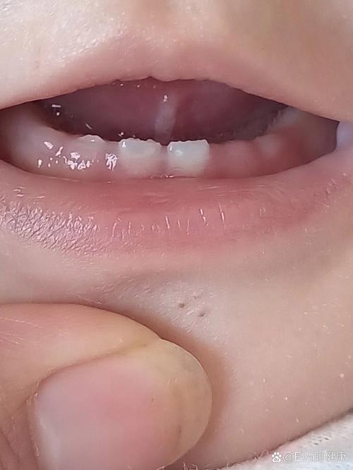 新生儿舌头白色物是何物？需处理吗？-第1张图片-郑州医学网