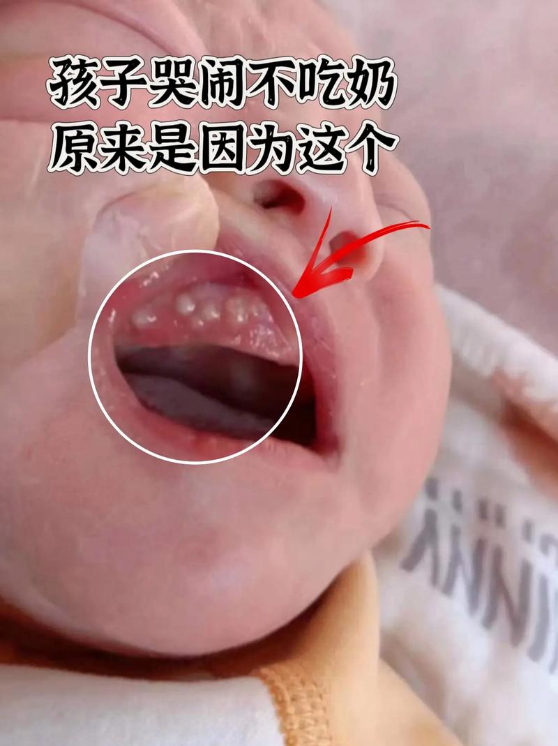 新生儿舌头白色物是何物？需处理吗？-第2张图片-郑州医学网