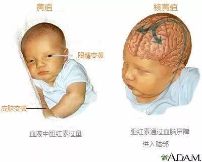 新生儿高胆红素血症后遗症-第3张图片-郑州医学网 新生儿高胆红素血症后遗症-第3张图片-郑州医学网