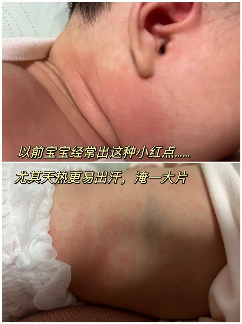 新生儿高胆红素血症后遗症-第2张图片-郑州医学网 新生儿高胆红素血症后遗症-第2张图片-郑州医学网