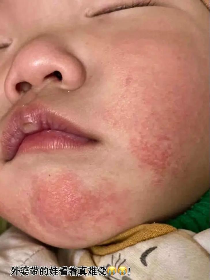 新生儿脸红是皮肤问题还是疾病信号？-第2张图片-郑州医学网