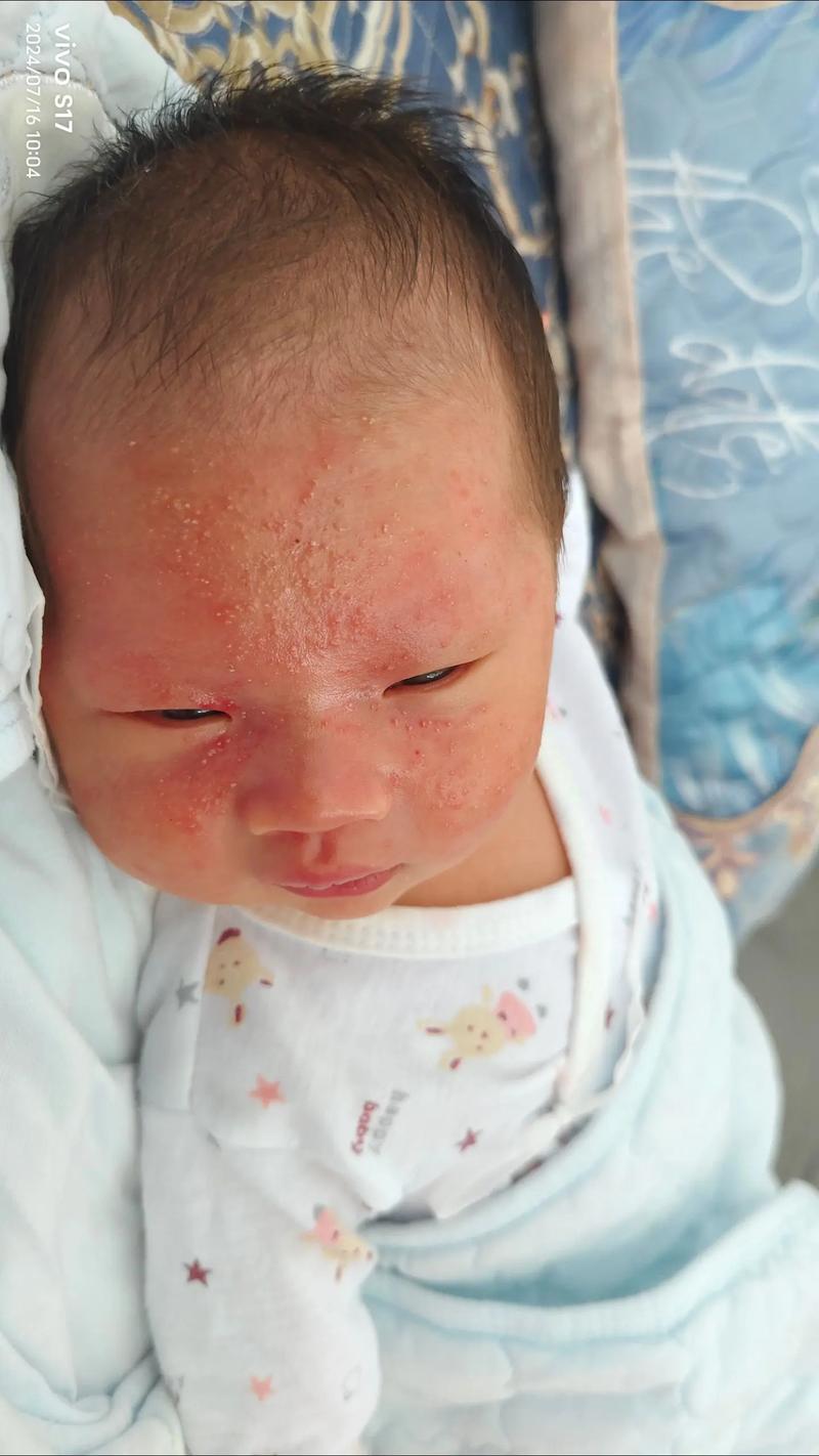 新生儿脸红是皮肤问题还是疾病信号？-第1张图片-郑州医学网