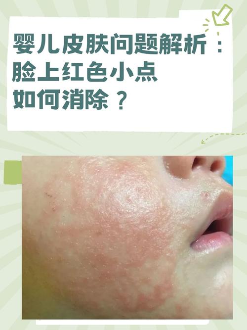 新生儿脸红是皮肤问题还是疾病信号？-第3张图片-郑州医学网