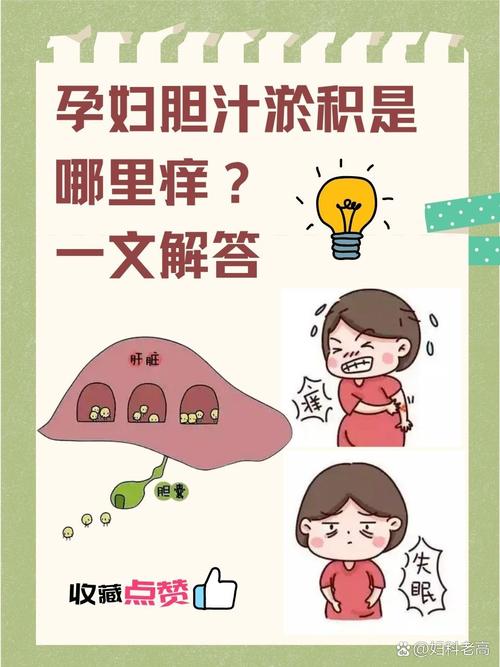 孕期胆汁酸高有哪些症状？-第2张图片-郑州医学网