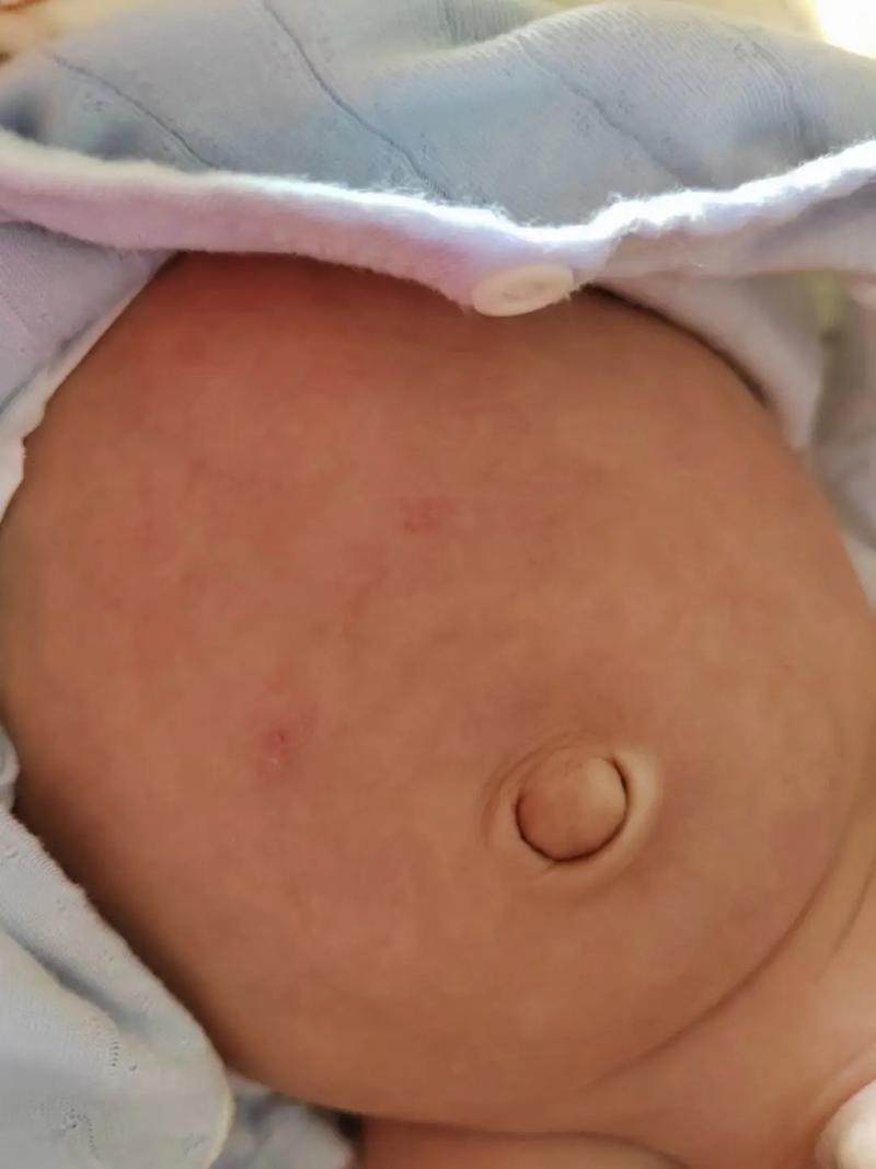 新生儿的肚子都是鼓鼓的吗-第1张图片-郑州医学网 新生儿的肚子都是鼓鼓的吗-第1张图片-郑州医学网