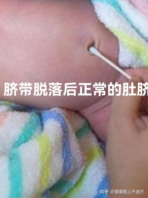 新生儿肚脐出血是什么原因-第3张图片-郑州医学网