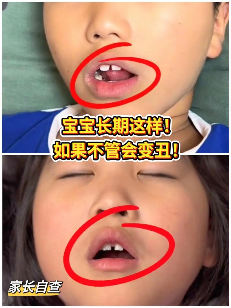 新生儿上唇突出正常吗？-第3张图片-郑州医学网