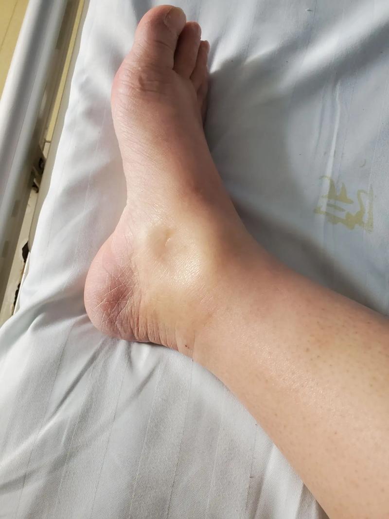 孕期脚肿真能判断胎儿性别吗？-第3张图片-郑州医学网