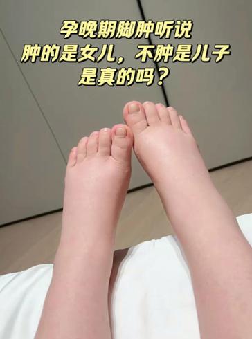 孕期脚肿真能判断胎儿性别吗？-第2张图片-郑州医学网