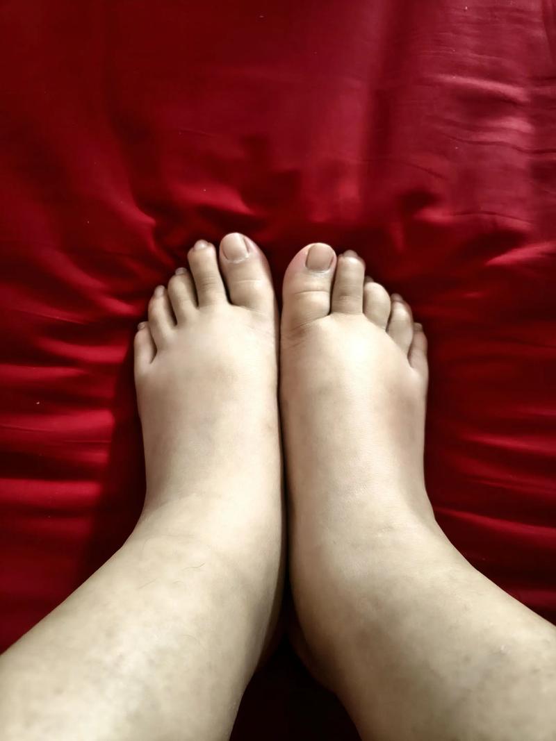 孕期脚肿真能判断胎儿性别吗？-第1张图片-郑州医学网