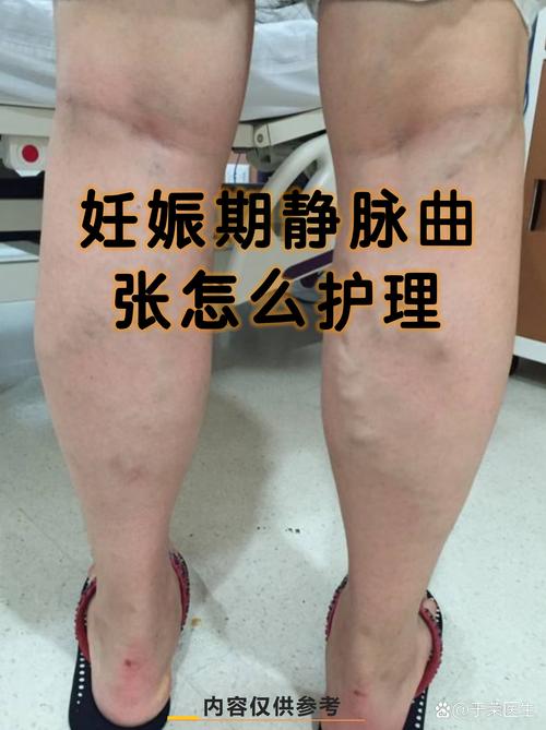 孕期静脉曲张怎么缓解？-第3张图片-郑州医学网