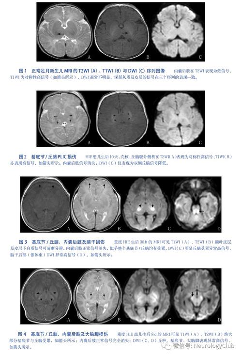 新生儿轻度缺氧缺血性脑病,能完全恢复吗?-第2张图片-郑州医学网 新生儿轻度缺氧缺血性脑病,能完全恢复吗?-第2张图片-郑州医学网