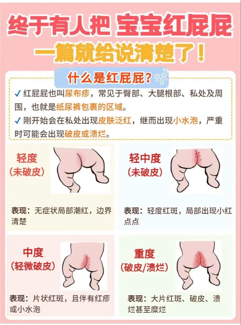 新生儿腹泻红屁股，如何有效护理？-第1张图片-郑州医学网