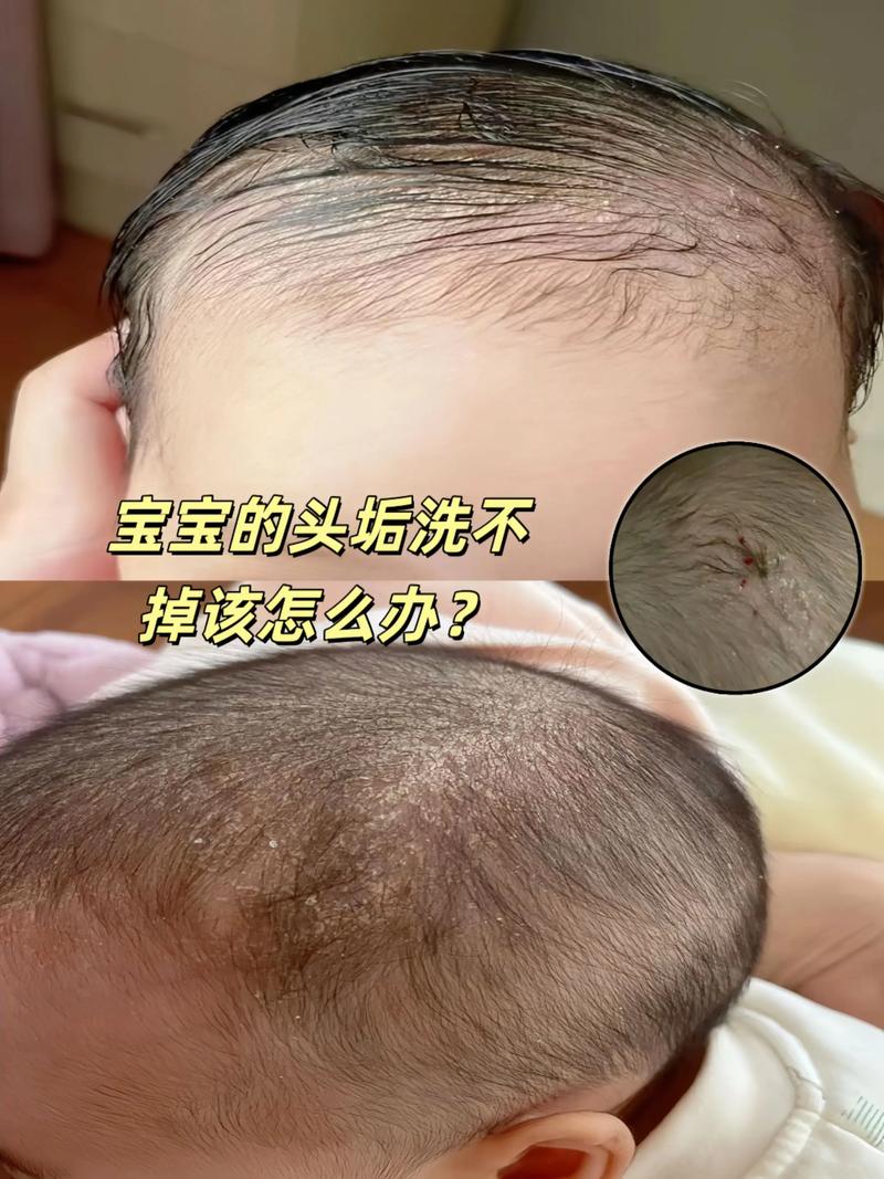 新生儿头上湿疹怎么办？-第3张图片-郑州医学网