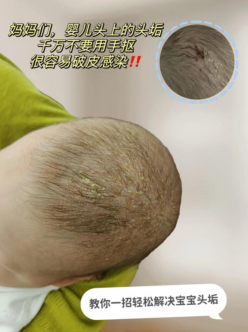 新生儿头上湿疹怎么办？-第1张图片-郑州医学网