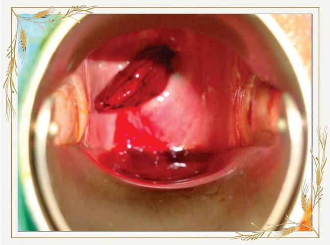 孕期宫颈息肉怎么办？-第3张图片-郑州医学网