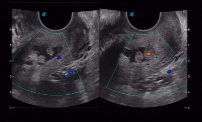孕期宫颈息肉怎么办?-第2张图片-郑州医学网 孕期宫颈息肉怎么办?-第2张图片-郑州医学网