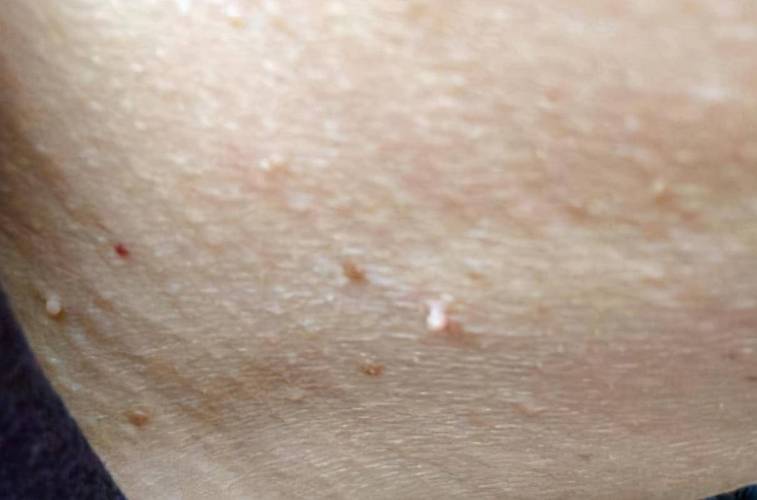 孕期阴唇小肉粒是何原因？-第2张图片-郑州医学网